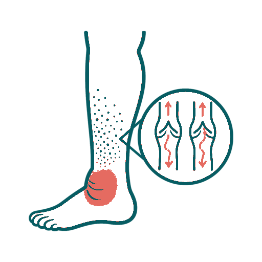 Chronic Venous Insufficiency icon