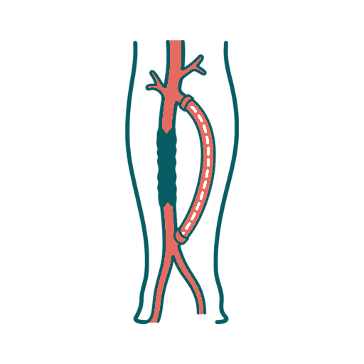 Lower-Limb Bypass Surgery icon